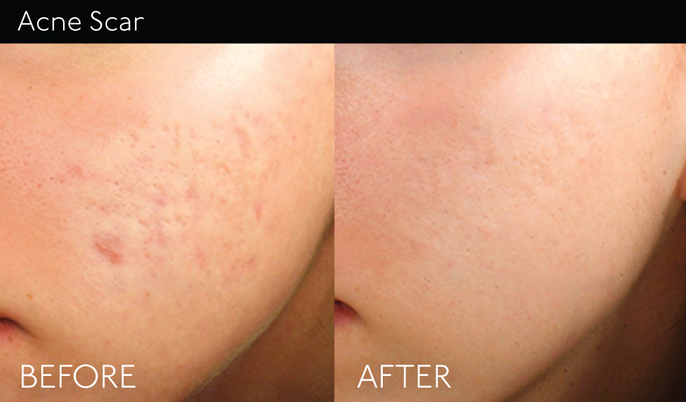 Acne-Scar copy