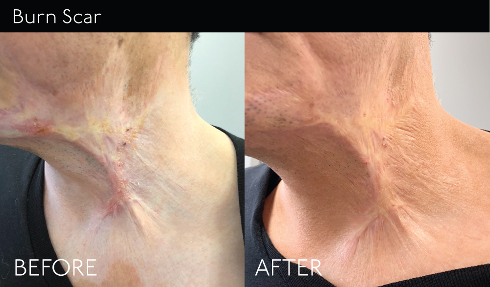 Burn-Scar copy