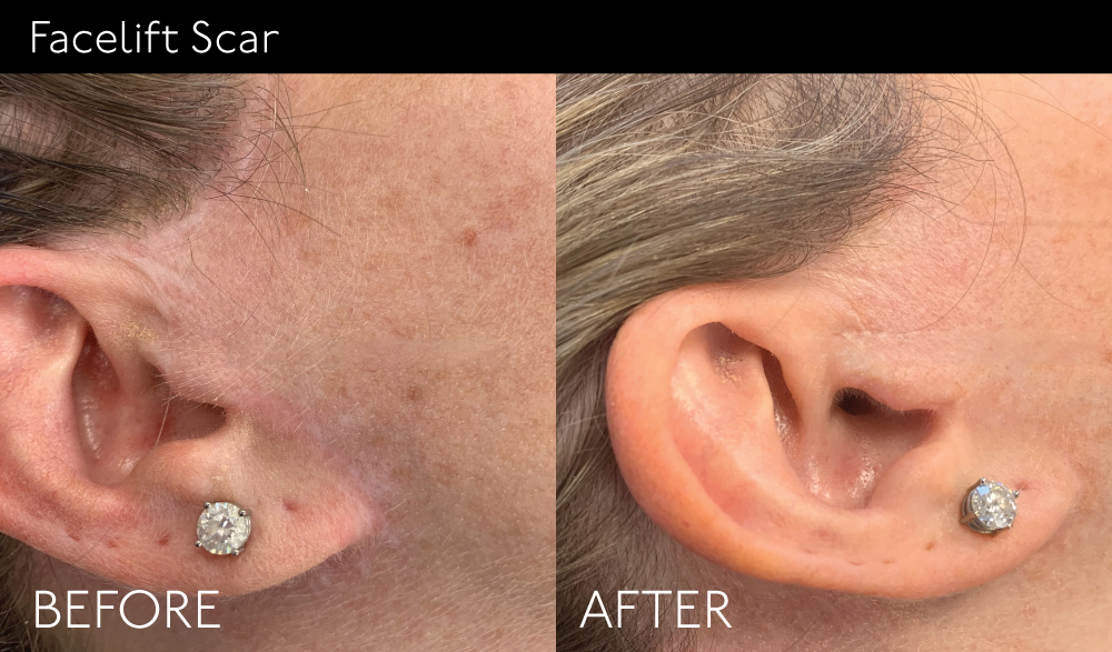 Facelift-Scar copy