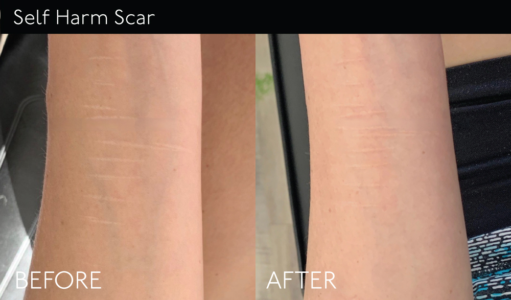 SelfHarm-Scar1 copy