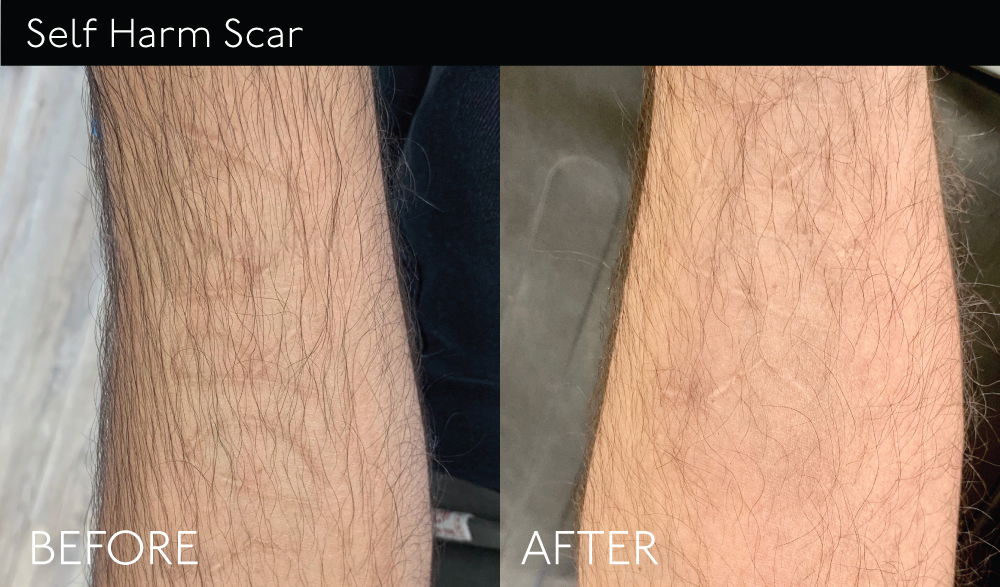 SelfHarm-Scar2 copy