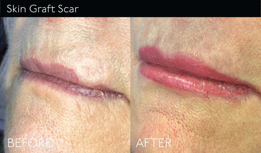 SkinGraft-Scar2 copy