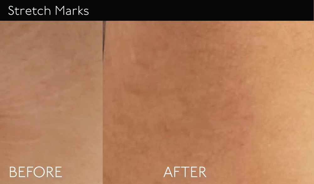 StretchMark copy