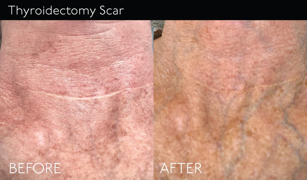 Thyroidectomy-Scar copy