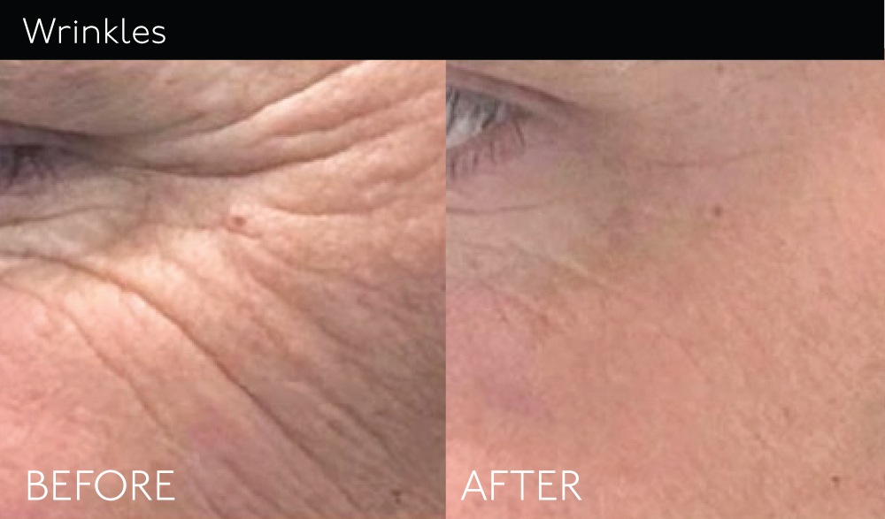 Wrinkles copy